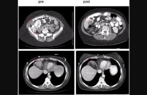 Figure 1: Pre- and post-treatment scans confirmed partial responder. (From a phase I trial of riluzole and sorafenib in patients with advanced solid tumors: CTEP #8850.”)