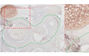 Figure 1: Multi-clonal ER expression in DCIS.