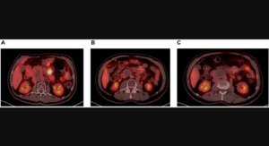 Figure 1: PET scan at screening (A), 5 months (B) and 8 months on treatment (C). CDK9 INHIBITORS