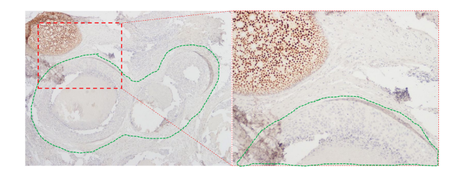 Figure 1: Multi-clonal ER expression in DCIS. Right hand panel (Magnification 20×) shows an area within the left-hand panel (Magnification 10×) containing adjacent CIS ducts with and without (encircled in green dotted line) ER expression.