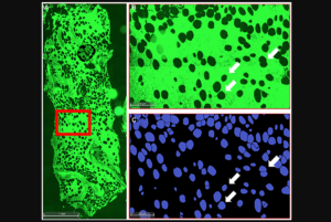 Figure 1: Histological analysis of iliac crest bone biopsy.