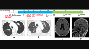 Figure 1: Treatment timeline with chest computed tomography (CT) and brain magnetic resonance images (MRI) on osimertinib.