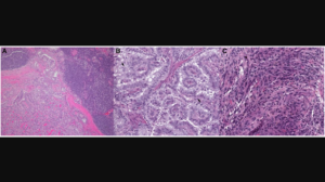 Figure 1: Representative histopathologic slides stained with hematoxylin and eosin of thyroid cancer from well-differentiated to dedifferentiated states.