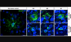 Figure 2: BCAS1+ cells in diffuse gliomas are morphologically different from BCAS1+ cells in healthy brain tissue.