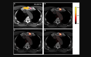 Figure 5: AI-generated PET results shown overlaid on CT.