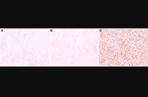 Figure 1: Cyclin D1 protein expression by immunohistochemistry in histological sections.