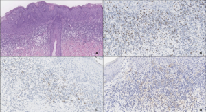 Early Immune Evasion Found in HPV-Related Pre-Cancer Lesions of the Anogenital Region
