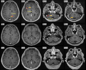 Rare Non-Small Cell Lung Cancer with Brain Metastases Responds to Amivantamab Monotherapy