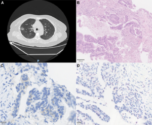 HER2-Mutated NSCLC in Brazil Shows Diverse Genetic Patterns and Treatment Gaps