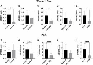 Lower LRIG1 Expression Linked to Aggressive Gliomas
